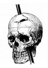 rod impaled through skull
