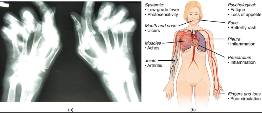 (a) Extensive damage to the right hand of a rheumatoid arthritis sufferer is shown in the x-ray. (b) The diagram shows a variety of possible symptoms of systemic lupus erythematosus.