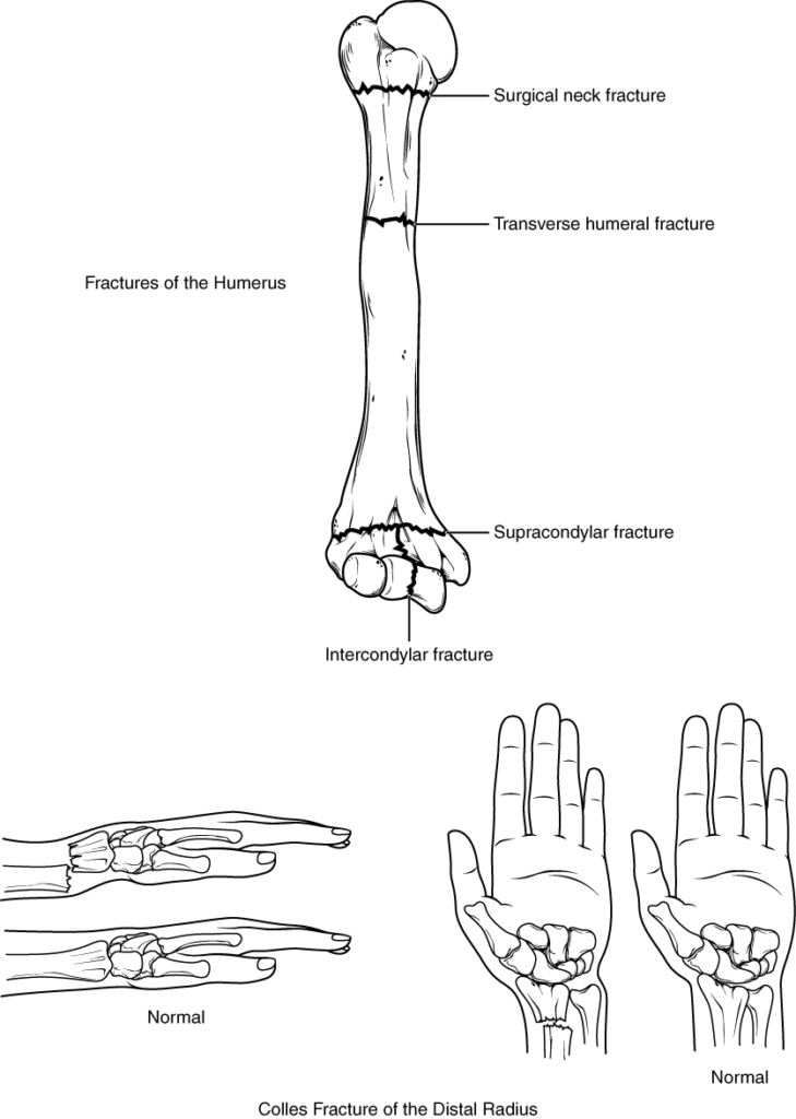 Diagram of Fractures of the humerus and radius