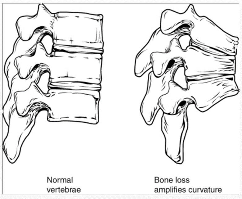Diagram of normal vertbrae and bone loss