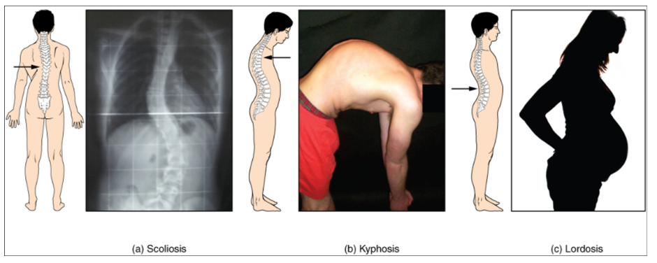 Photos of abnormal curvatures of the vertebral column (a) Scoliosis is an abnormal lateral bending of the vertebral column. (b) An excessive curvature of the upper thoracic vertebral column is called kyphosis. (c) Lordosis is an excessive curvature in the lumbar region of the vertebral column.